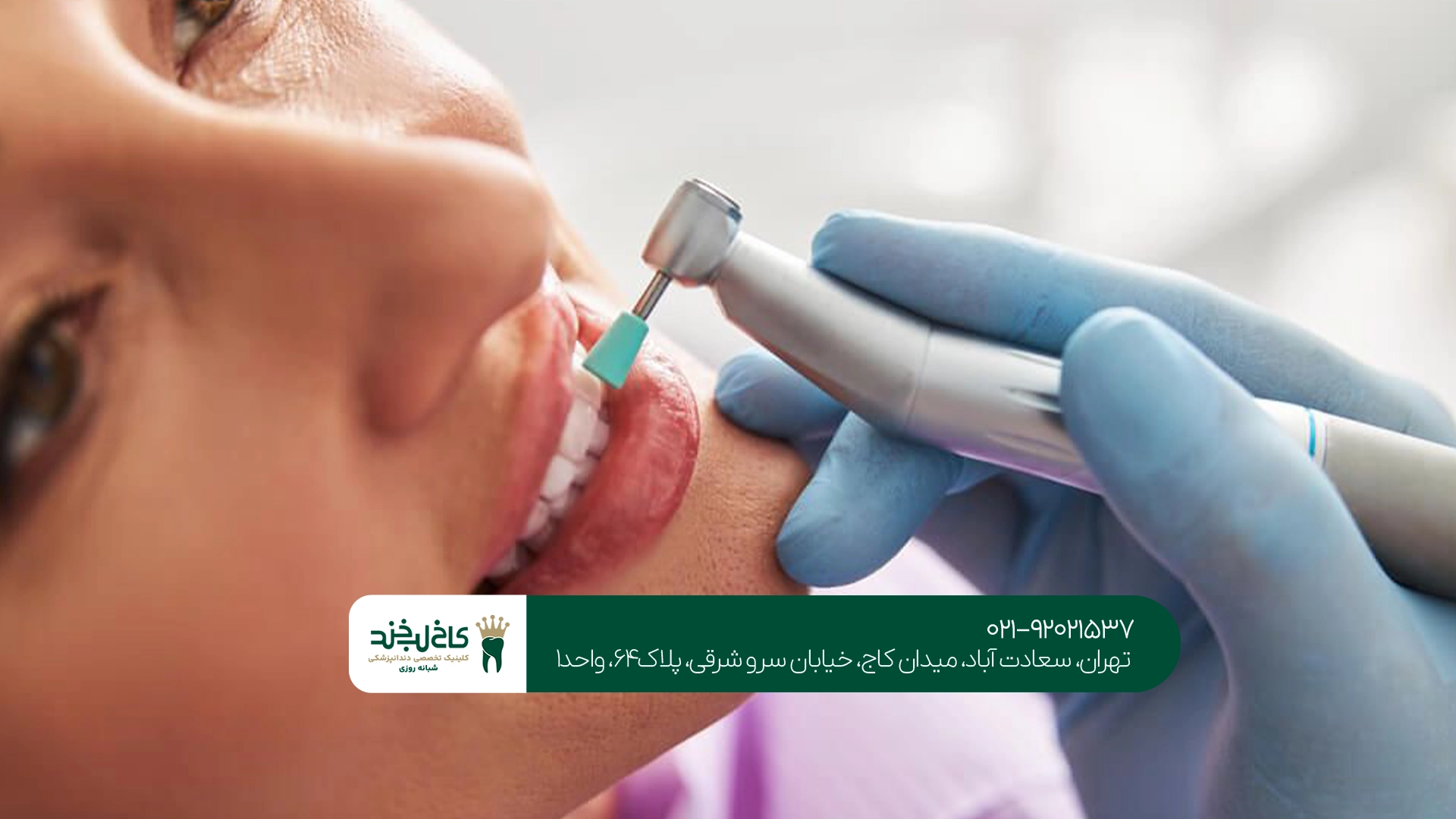 مراحل جرمگیری دندان در کاخ لبخند مراحل جرمگیری دندان در کاخ لبخند