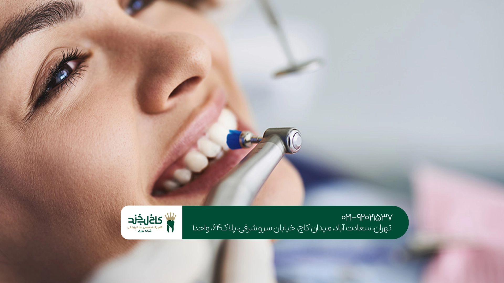 تفاوت جرمگیری با بلیچینگ دندان تفاوت جرمگیری با بلیچینگ دندان