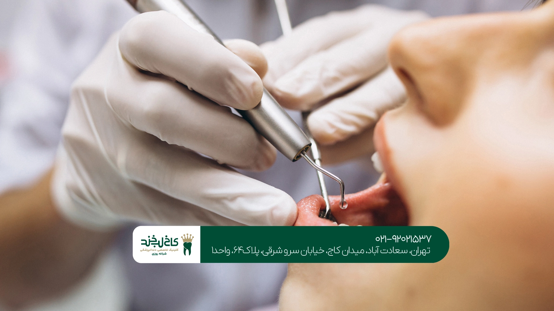 آیا جرمگیری باعث فاصله افتادن بین دندانها میشود؟ آیا جرمگیری باعث فاصله افتادن بین دندانها میشود؟