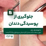 جلوگیری از پوسیدگی دندان