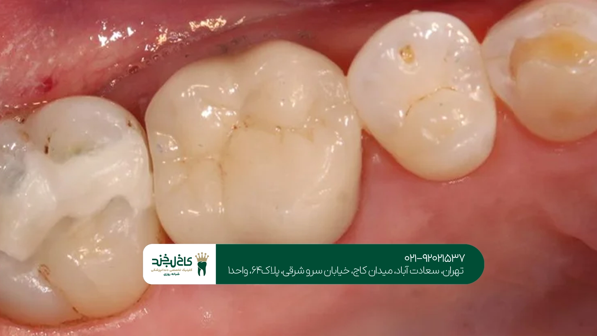 چگونه از پوسیدگی دندان کودکان جلوگیری کنیم؟ چگونه از پوسیدگی دندان کودکان جلوگیری کنیم؟
