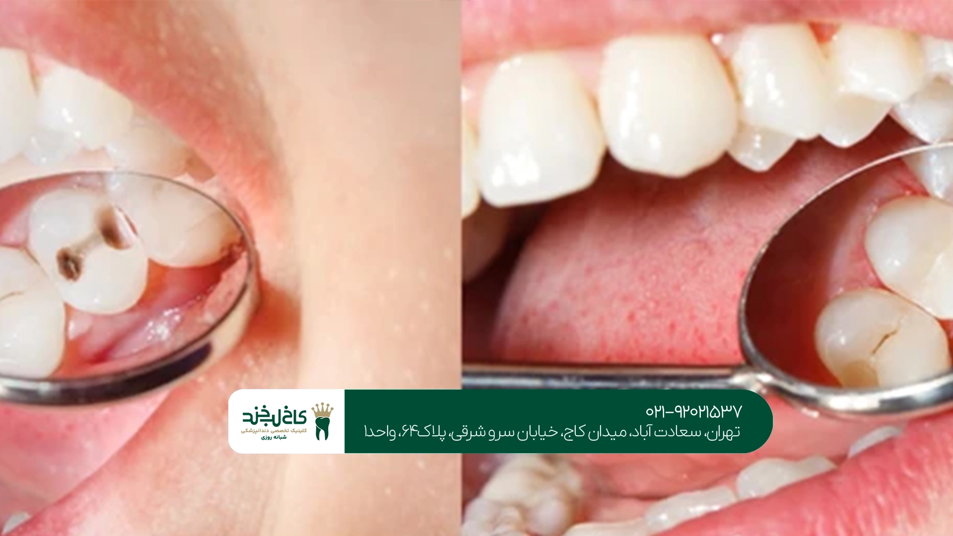 بهترین کلینیک پیشگیری از پوسیدگی دندان بهترین کلینیک پیشگیری از پوسیدگی دندان