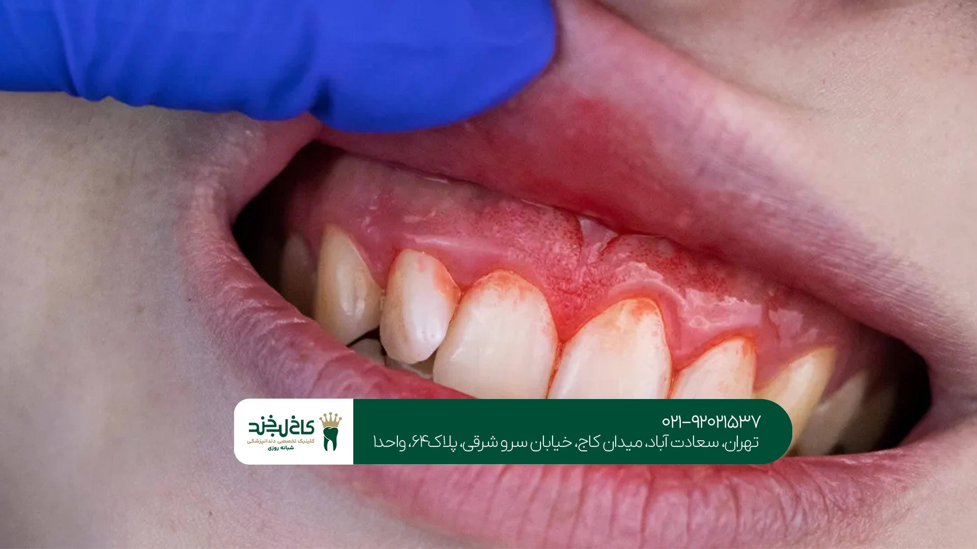 بهترین روش درمان بیماری لثه بهترین روش درمان بیماری لثه