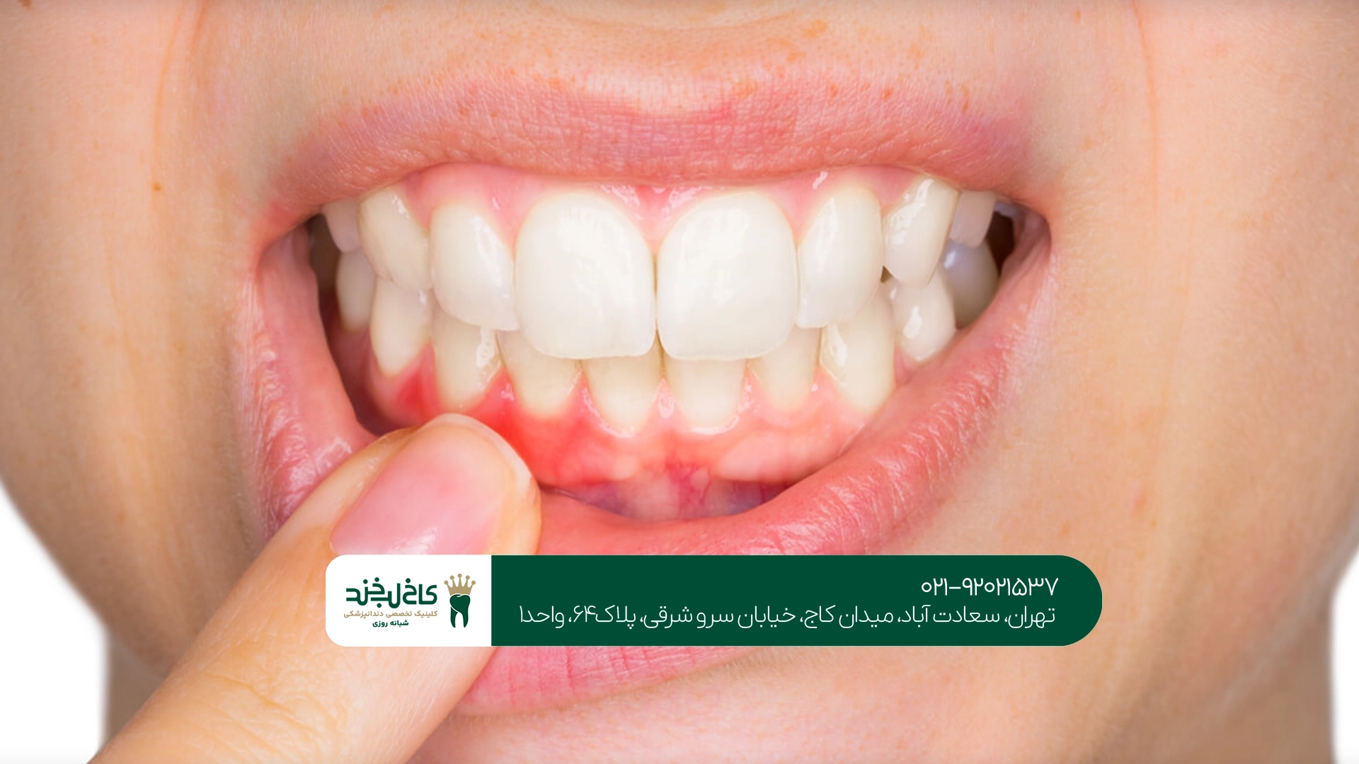 هزینه درمان بیماری لثه هزینه درمان بیماری لثه