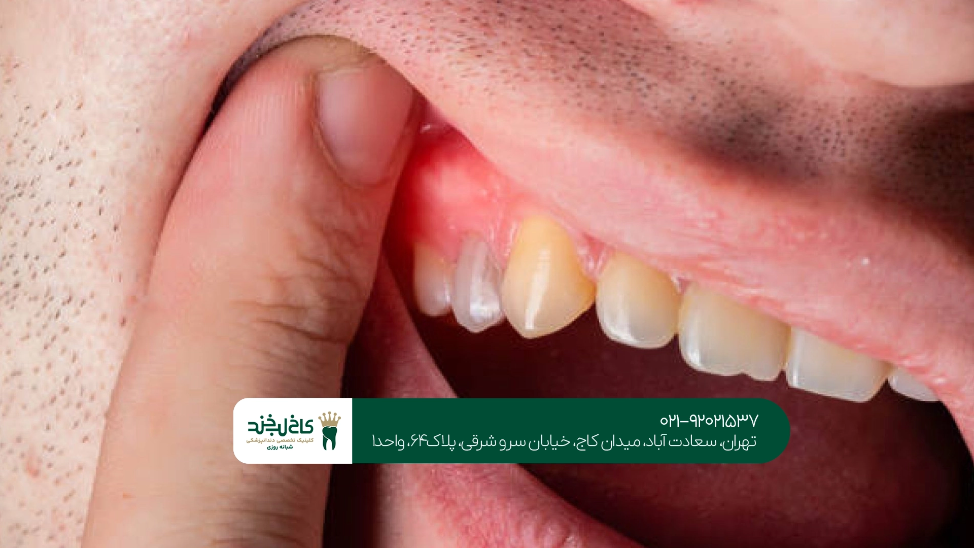 درمان تخصصی بیماریهای لثه در تهران درمان تخصصی بیماریهای لثه در تهران