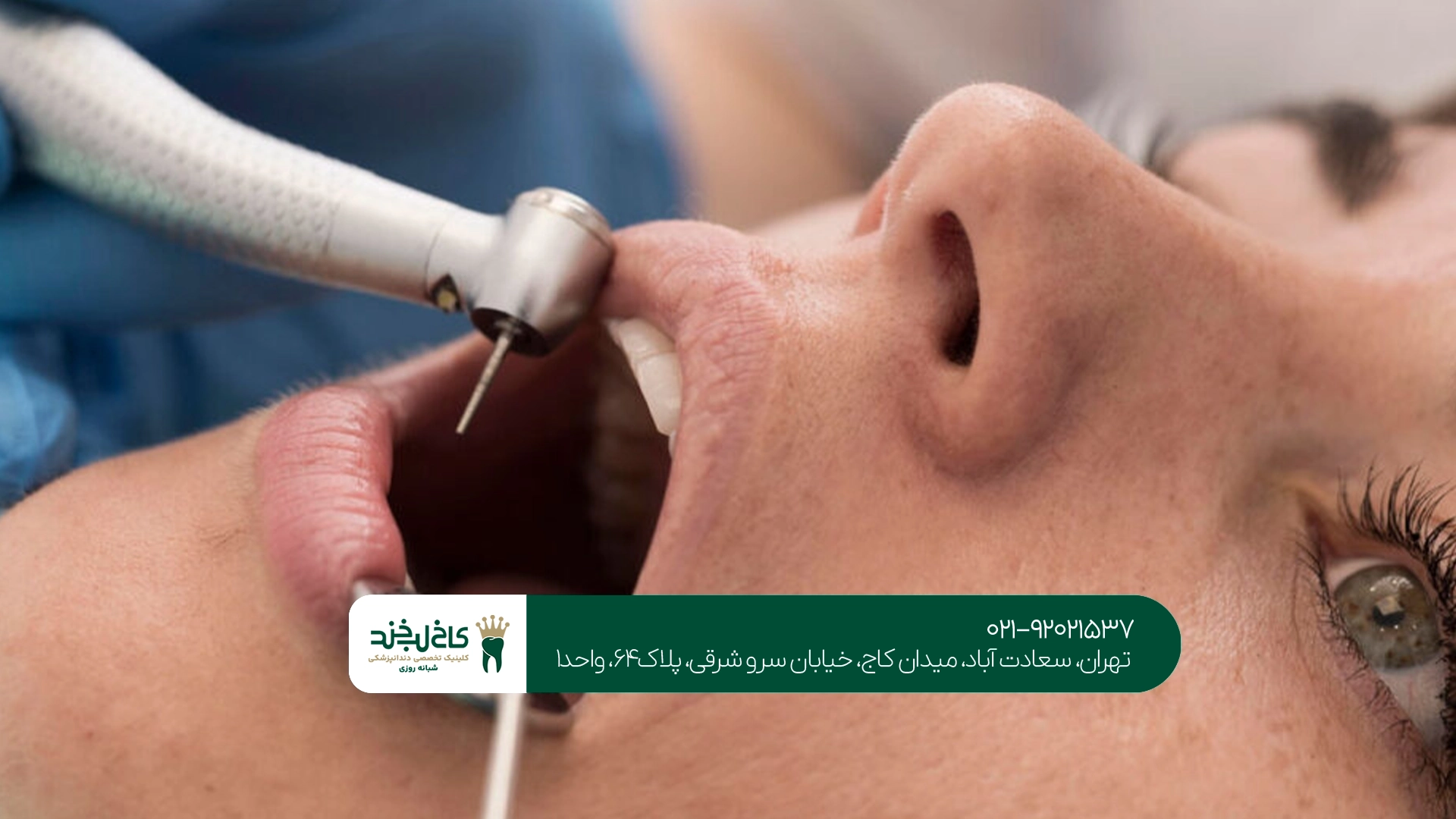 چگونه ماندگاری دندان پس از درمان ریشه را افزایش دهیم؟