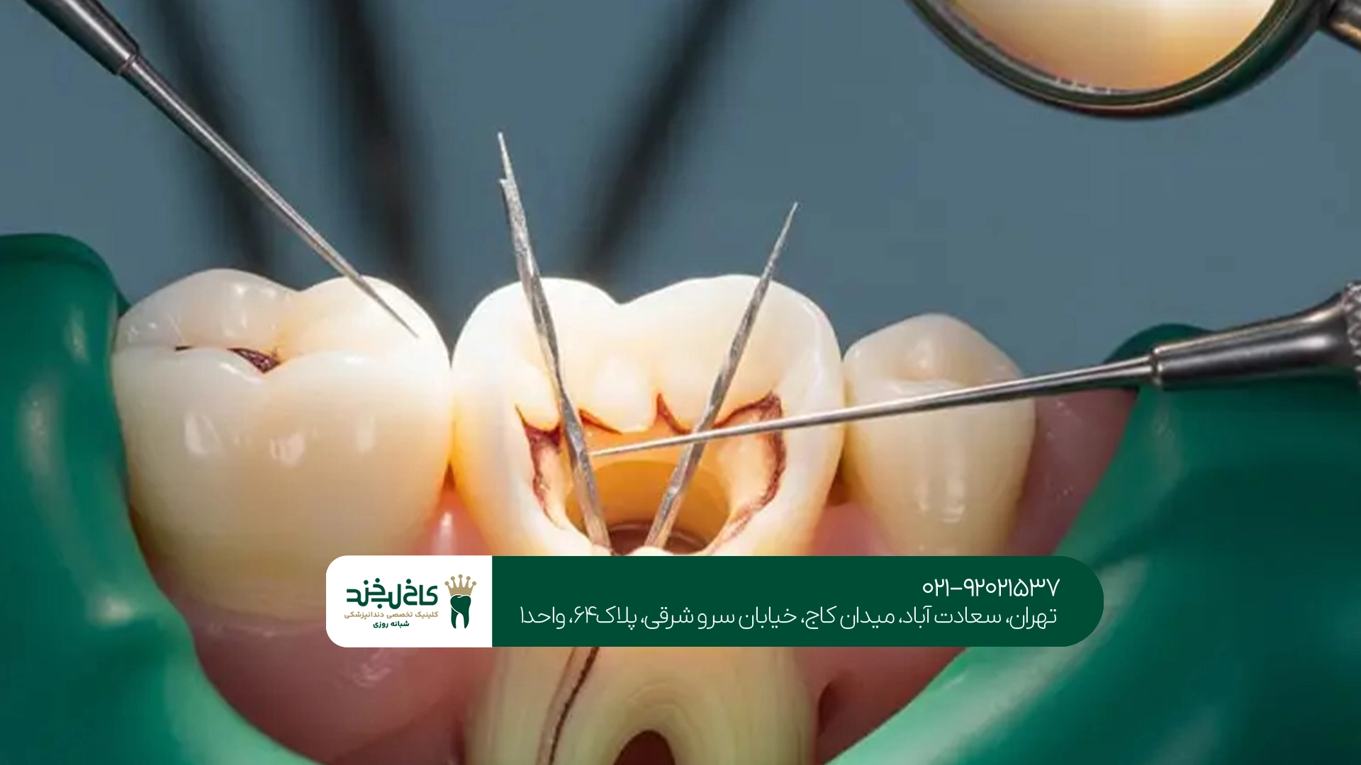 آیا درمان ریشه دندان درد دارد و چقدر طول میکشد؟