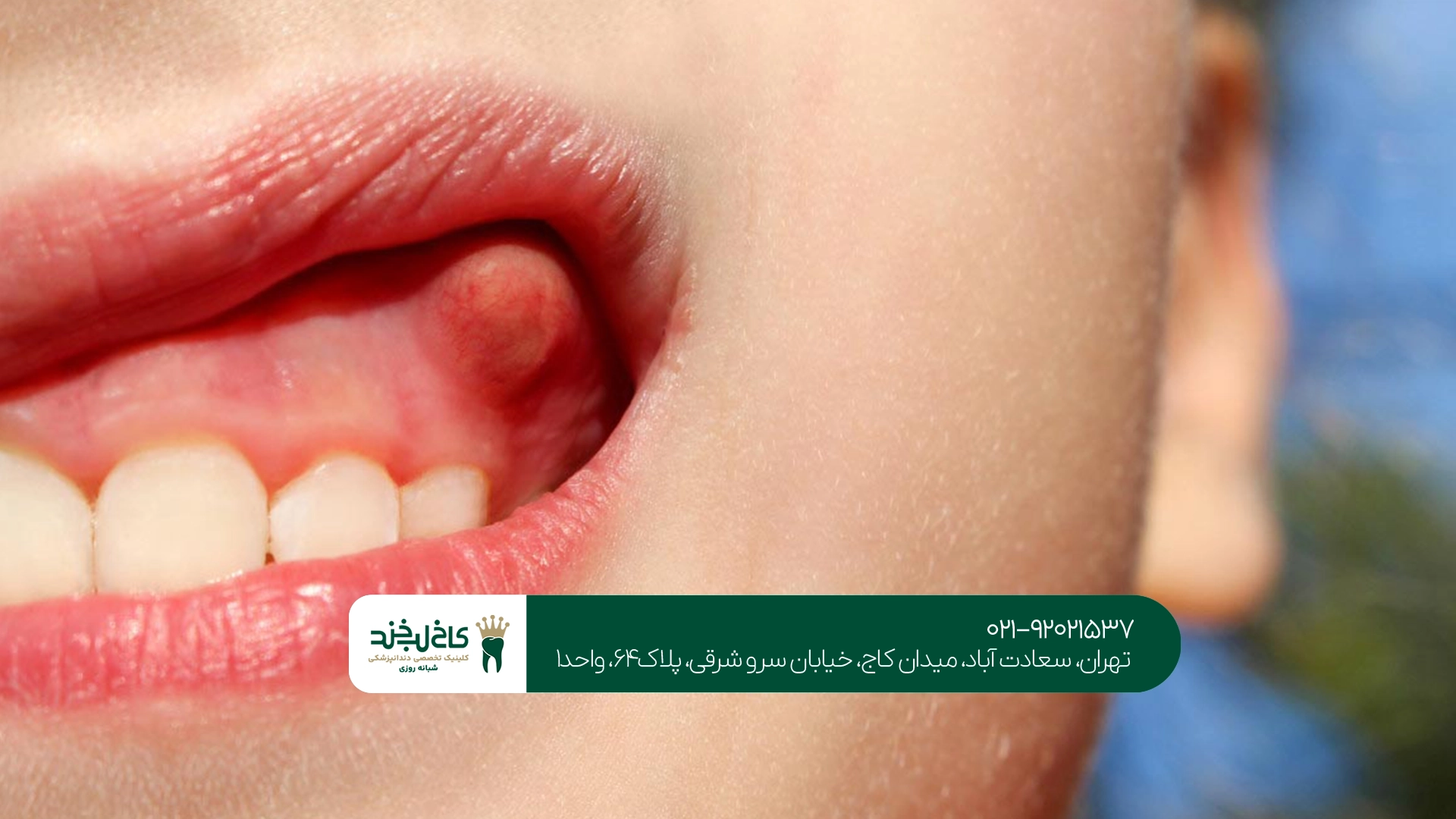 بهترین دندانپزشک درمان عفونت دندان