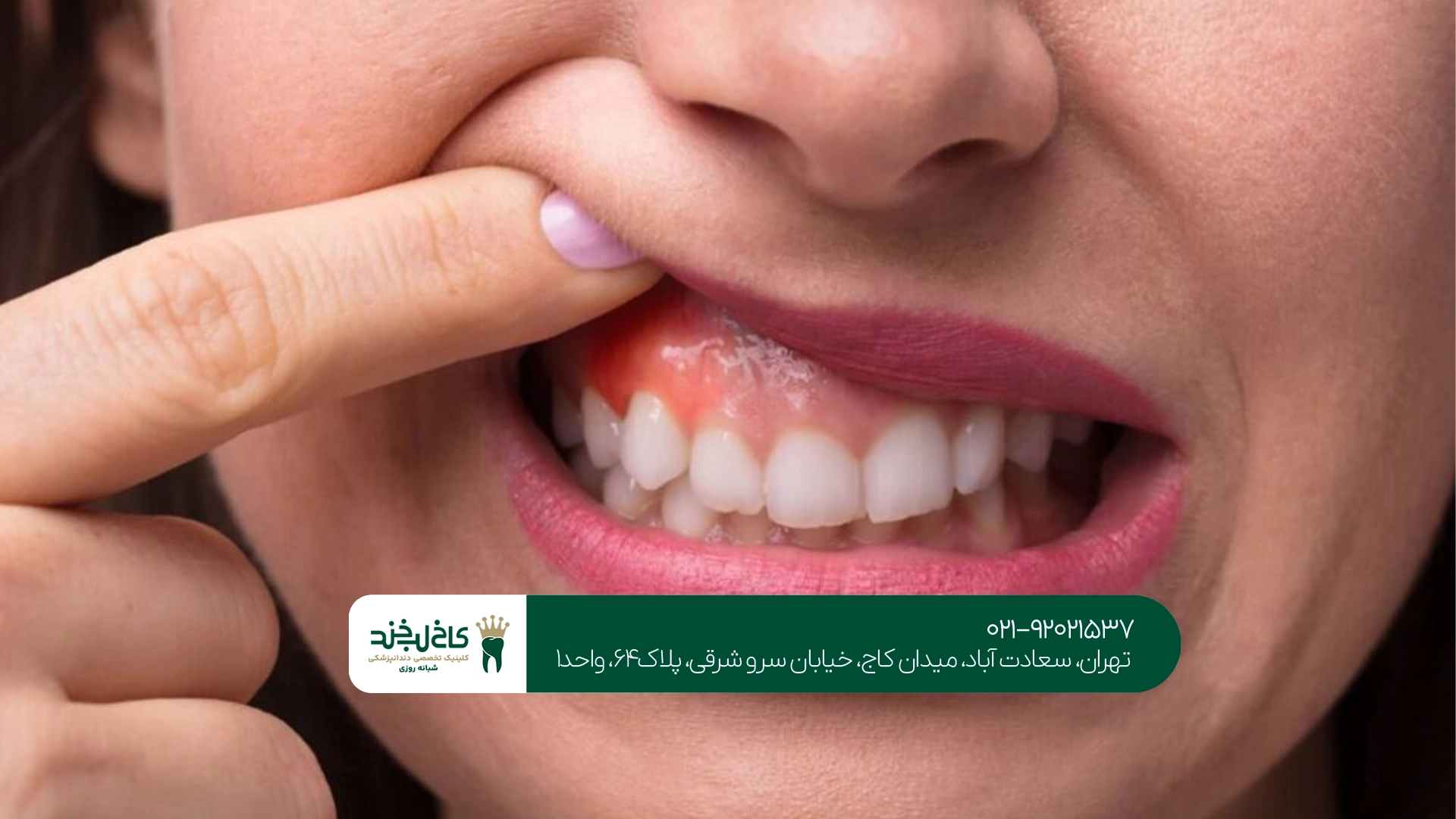 آیا عفونت دندان بدون درمان از بین میرود؟