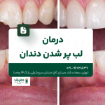 درمان لب پر شدن دندان