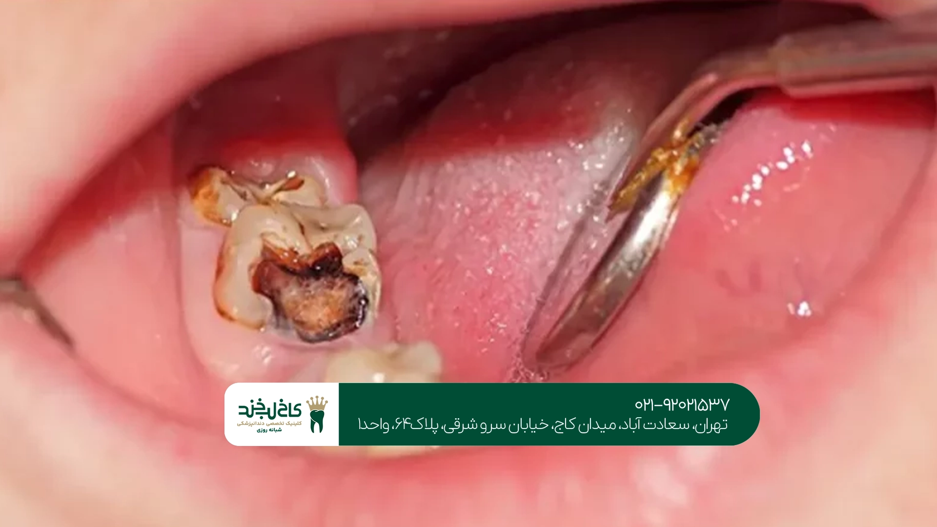 درمان پوسیدگی دندان در تهران