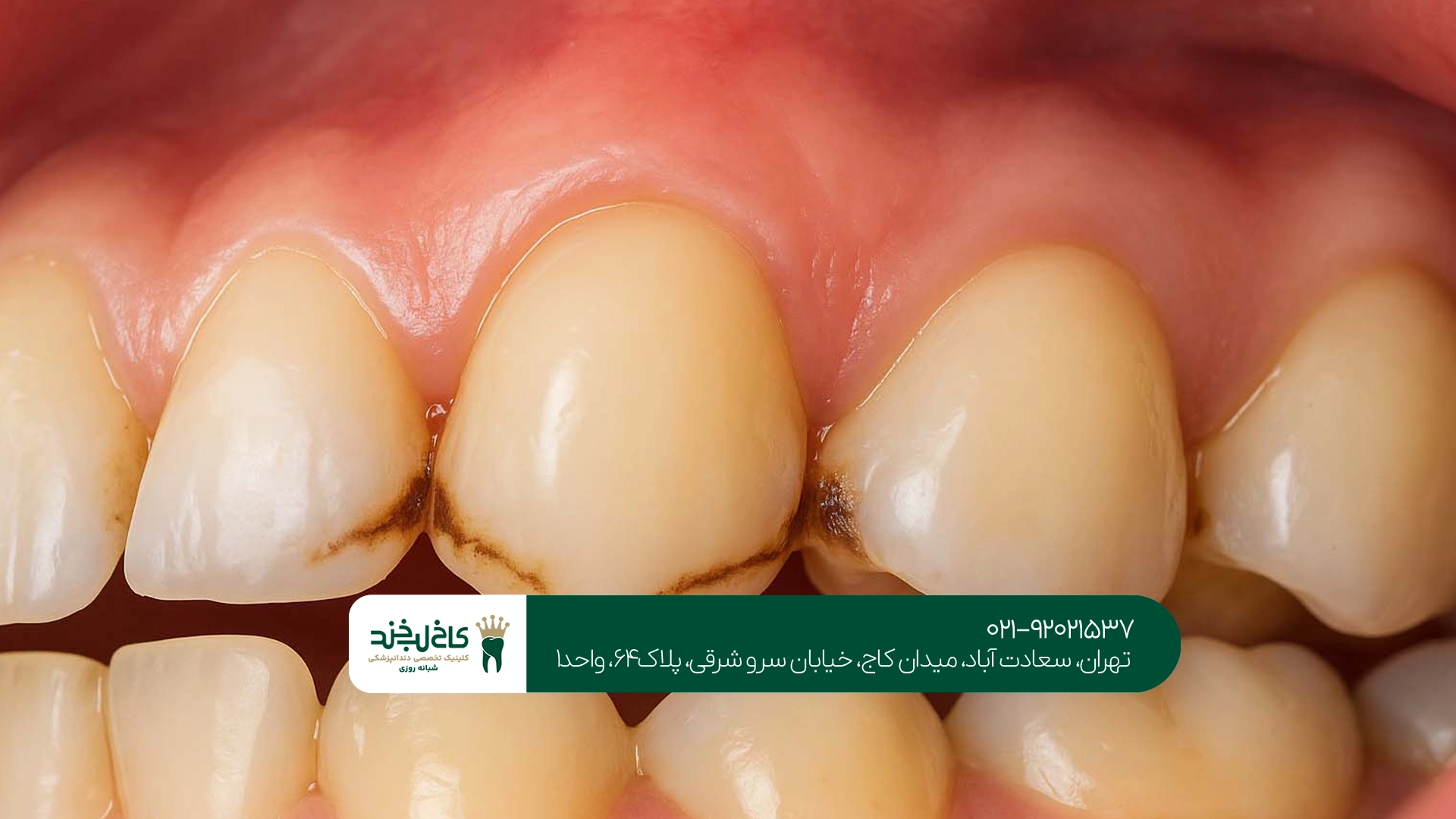 بهترین مرکز درمان پوسیدگی دندان