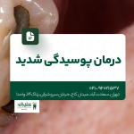 درمان پوسیدگی شدید