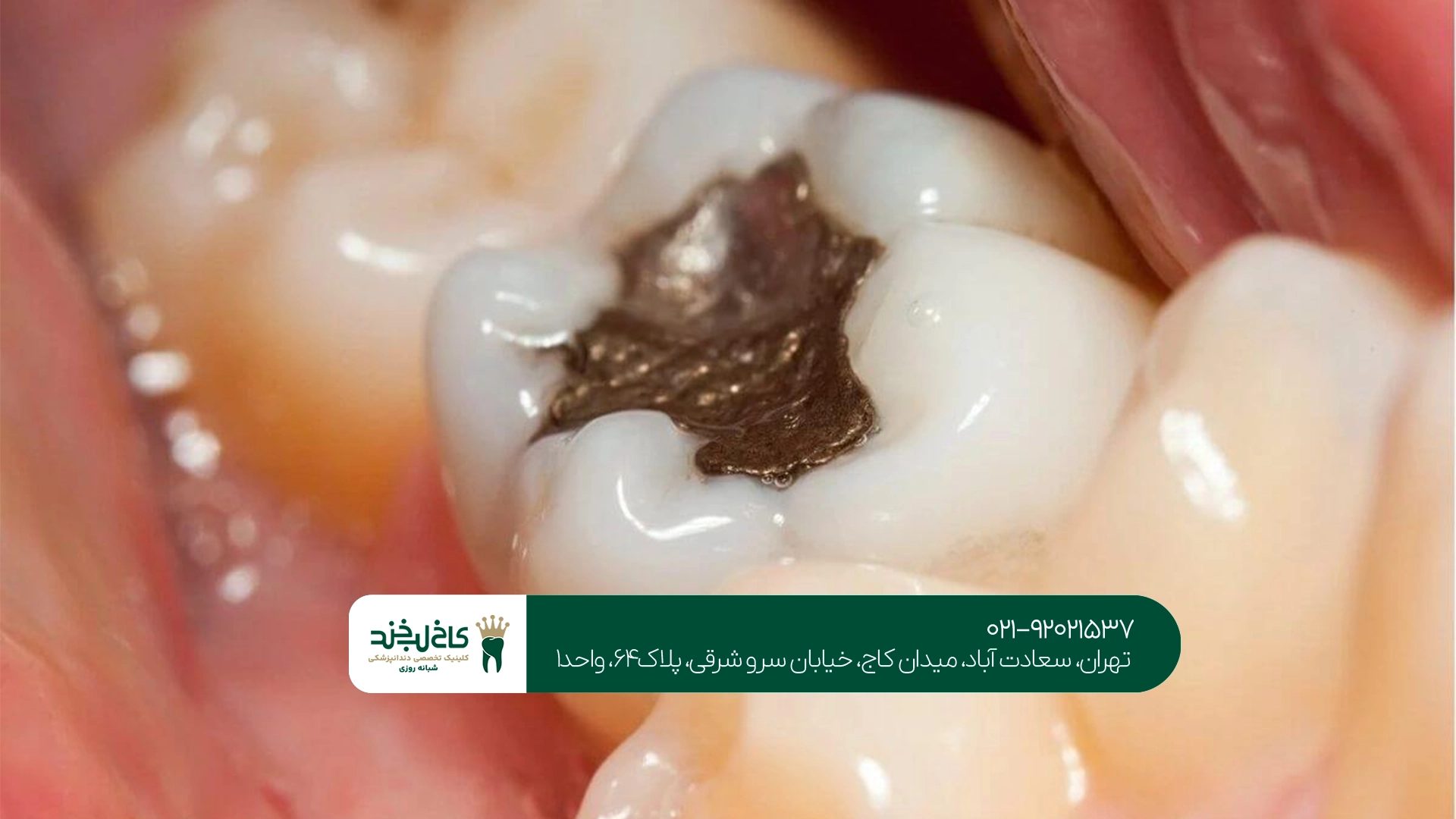 بهترین روش ترمیم دندان با پوسیدگی شدید چیست؟