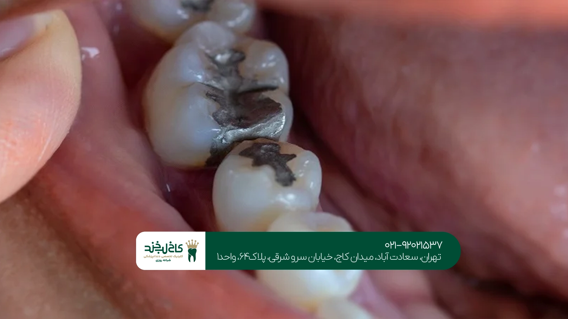 بهترین مرکز درمان پوسیدگی شدید دندان