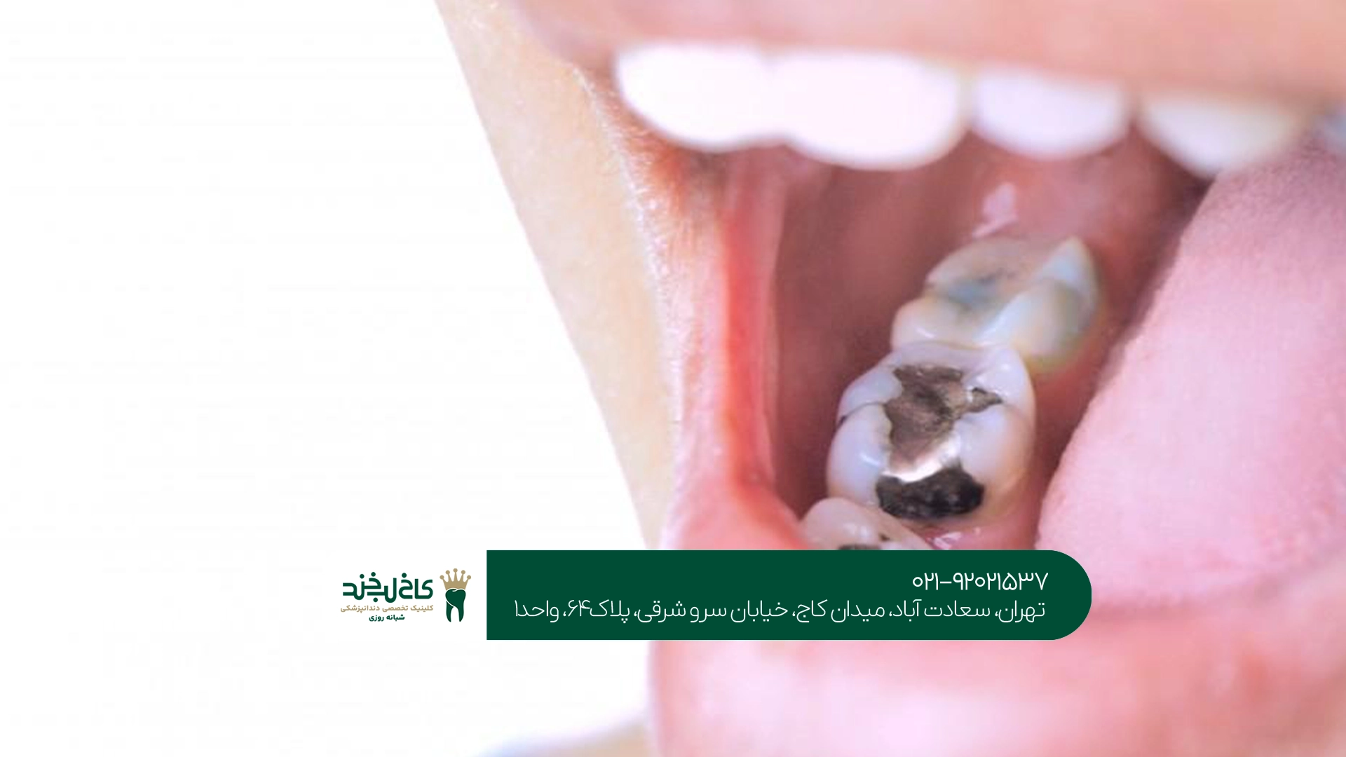 درمان پوسیدگی شدید دندان بدون درد