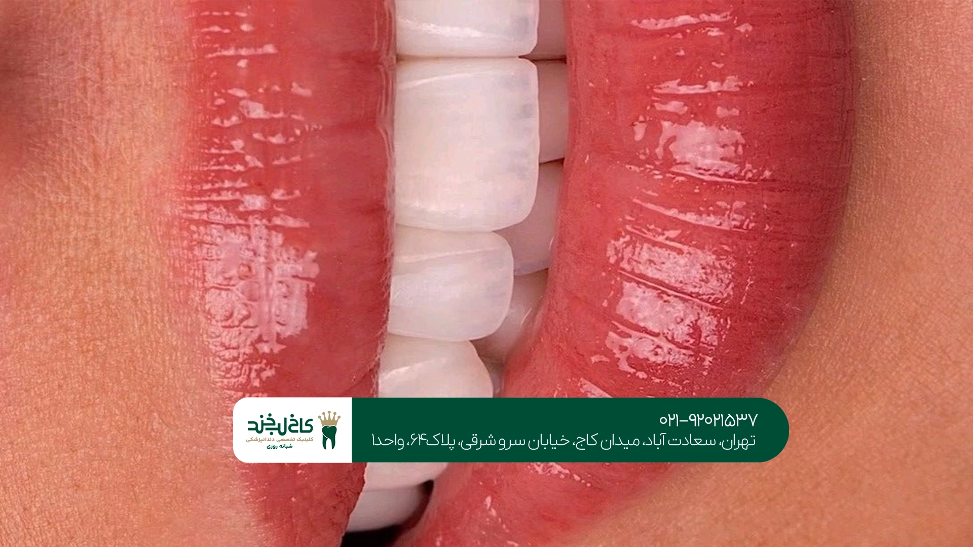 هزینه مرتب کردن دندان چقدر است؟