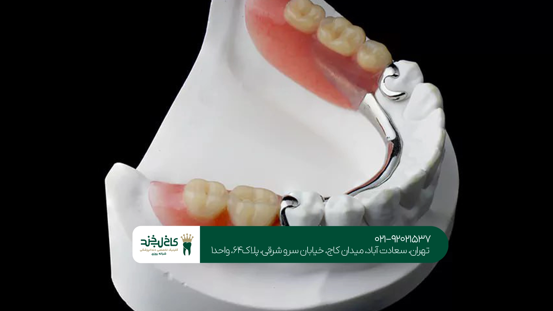 انواع دندان مصنوعی تکه ای انواع دندان مصنوعی تکه ای