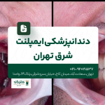 دندانپزشکی ایمپلنت شرق تهران