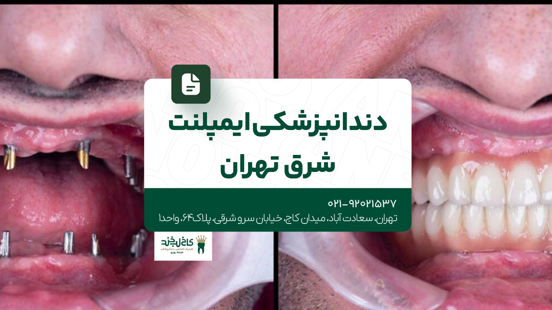 دندانپزشکی ایمپلنت شرق تهران
