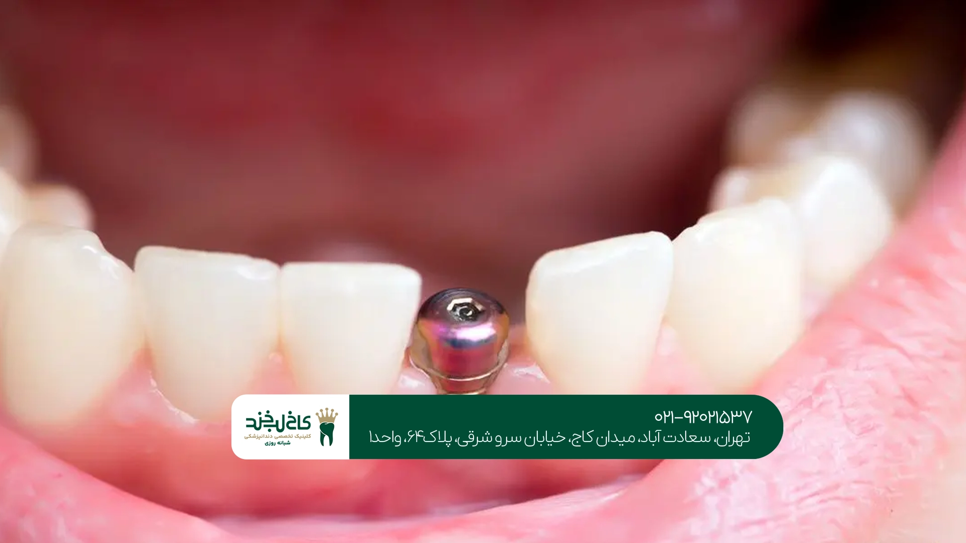 بهترین دندانپزشکی ایمپلنت شرق تهران