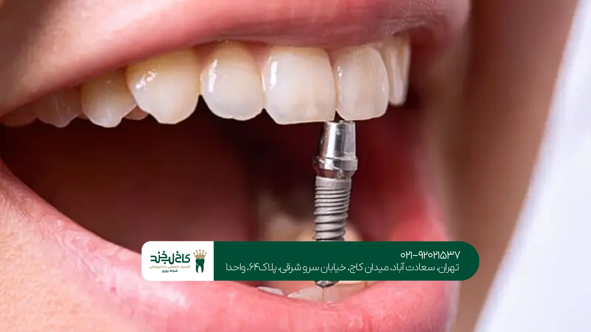 ایمپلنت تخصصی در شرق تهران