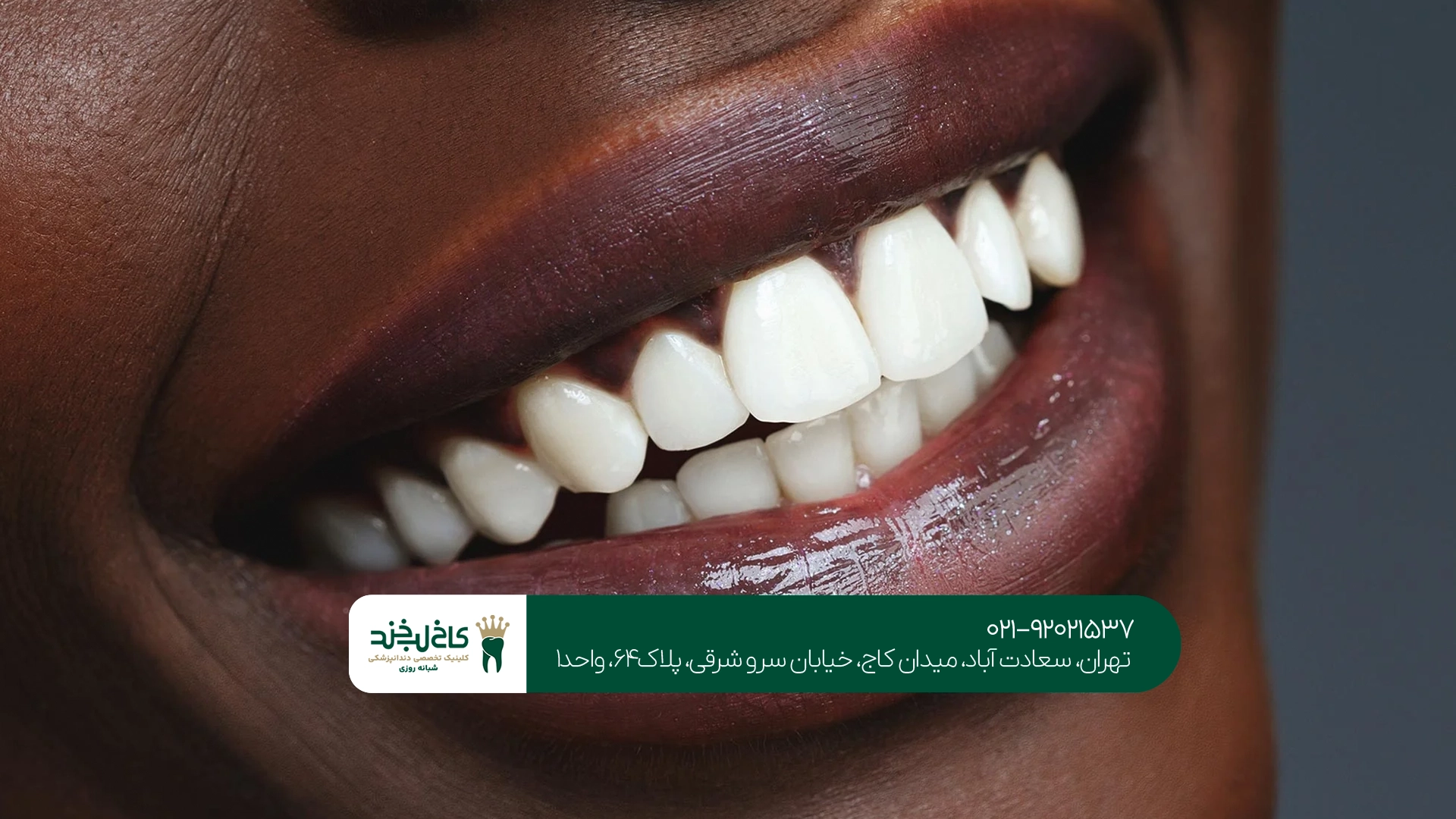 لمینت دندان در جنت آباد برای چه افرادی مناسب است؟