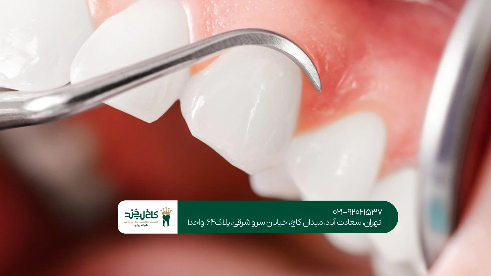 دندانپزشکی شهرک غرب برای ایمپلنت و جراحی دندان