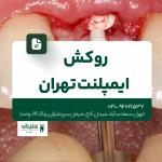 روکش ایمپلنت تهران
