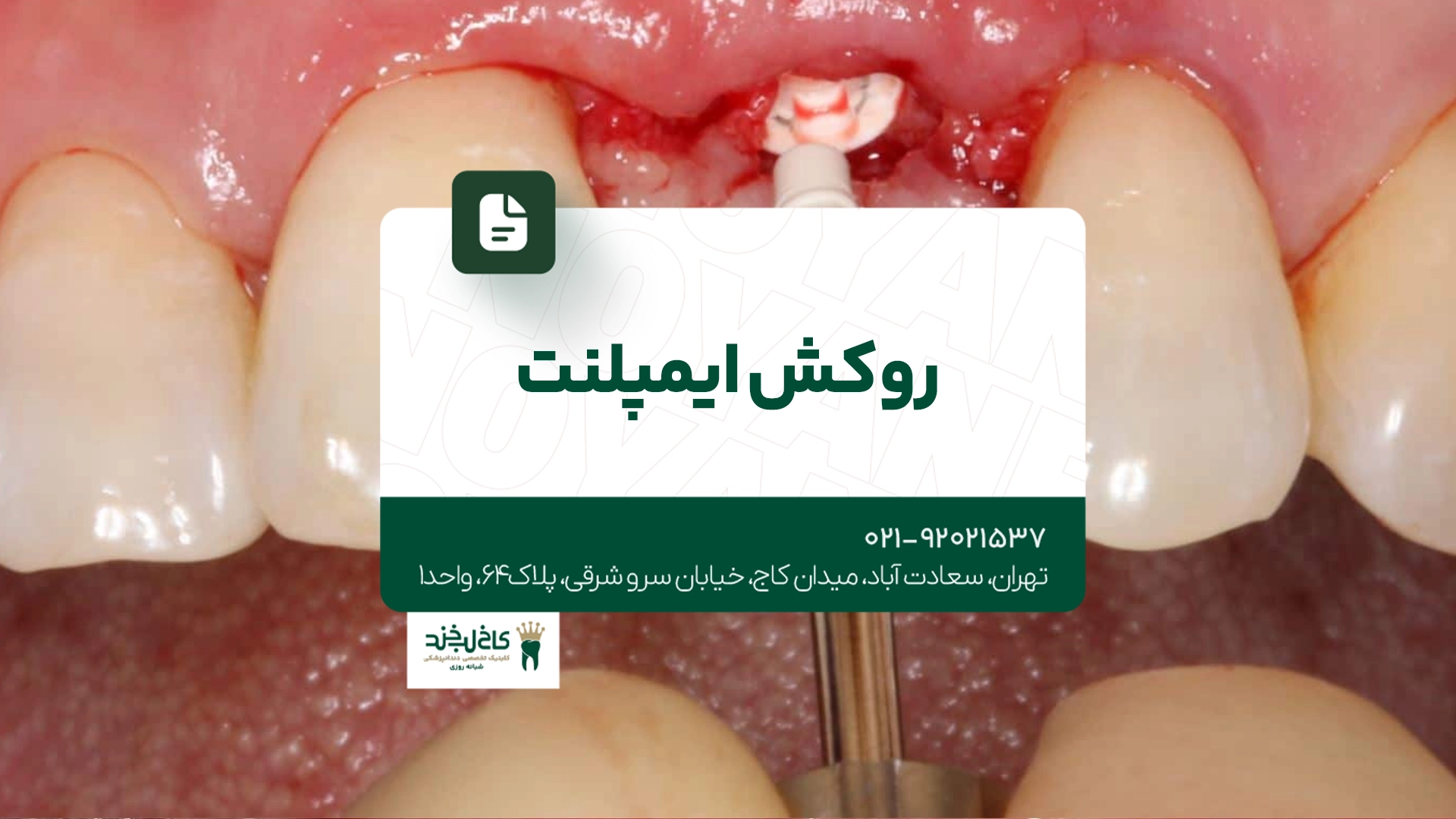 روکش ایمپلنت