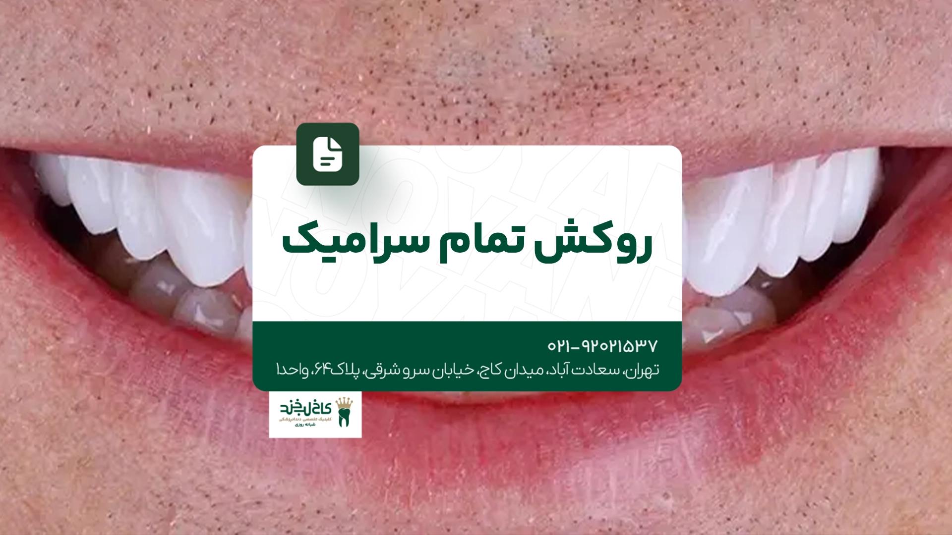 روکش تمام سرامیک
