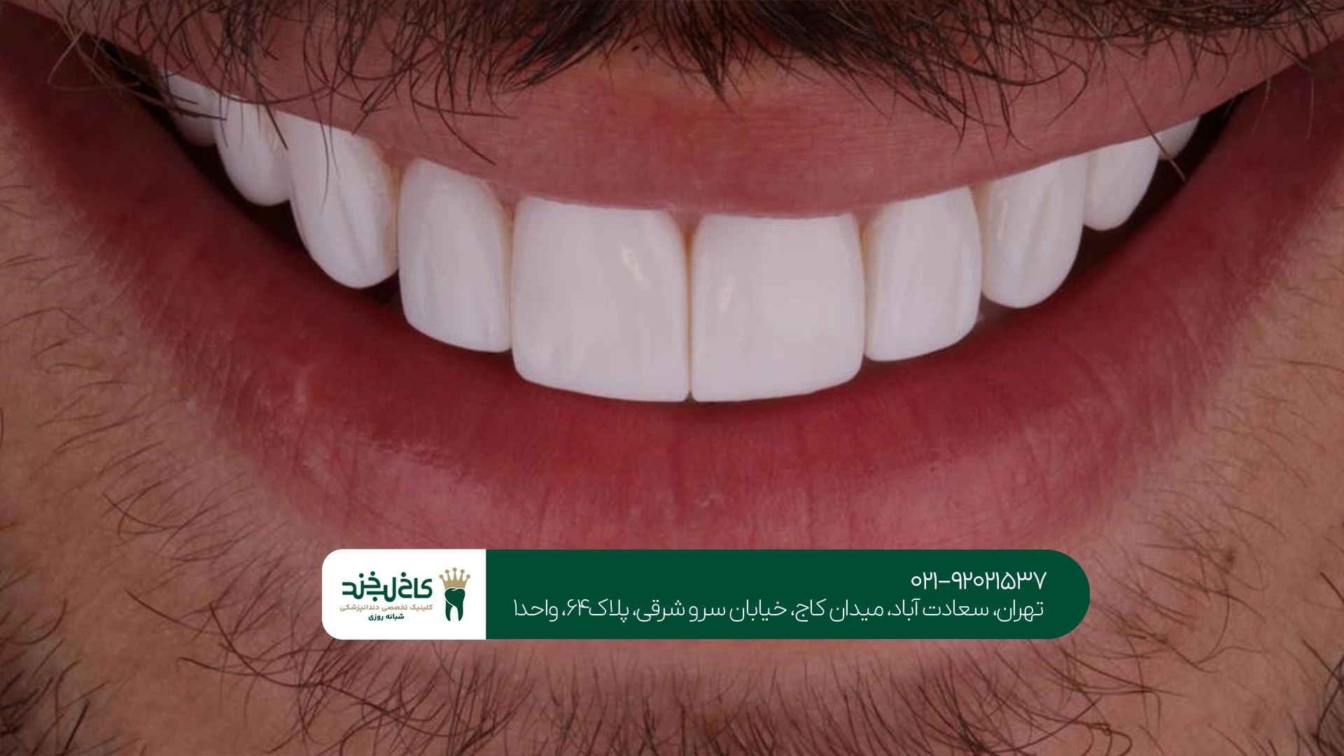 روکش تمام سرامیک اقساطی در تهران