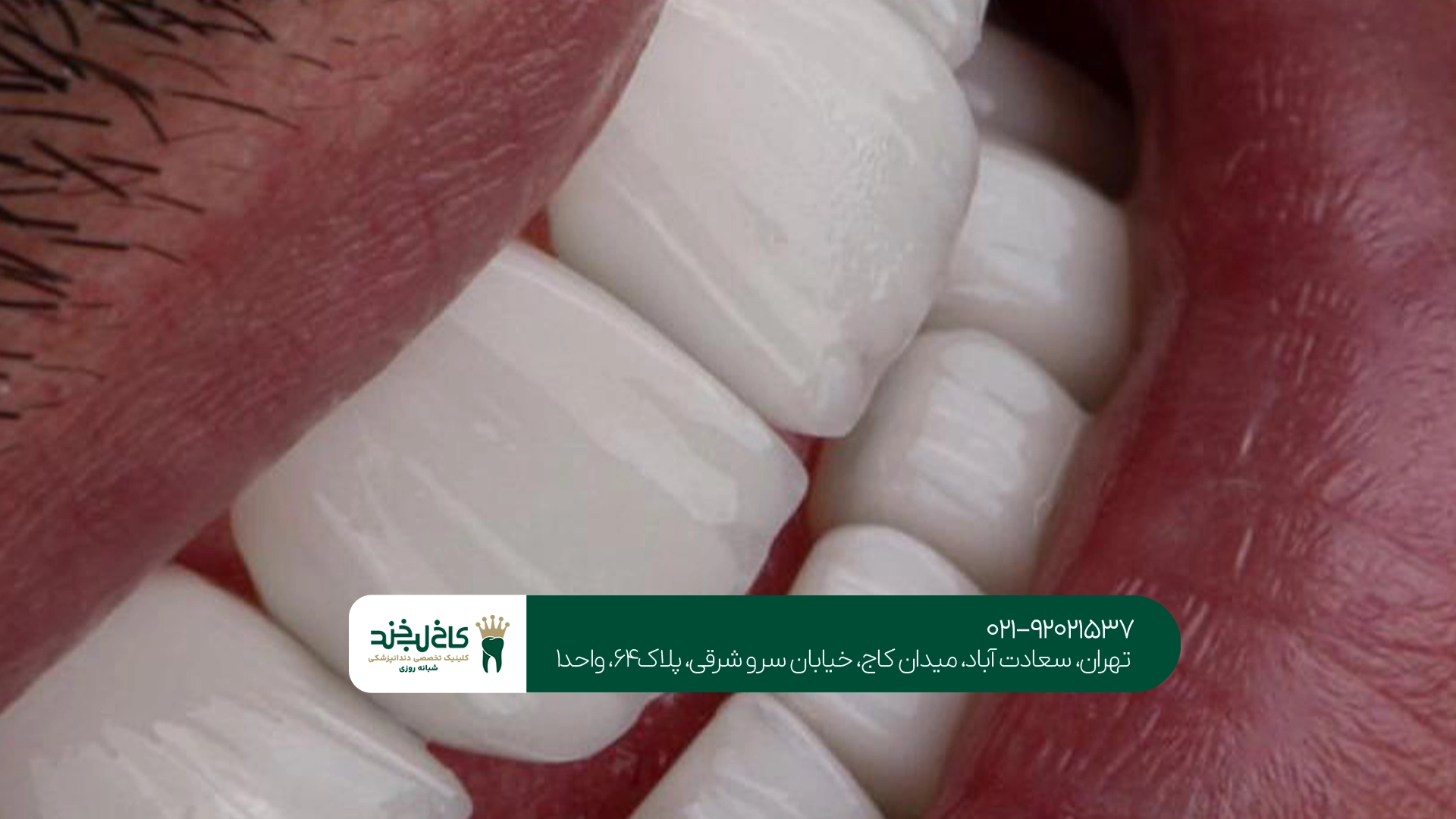 مرکز تخصصی روکش دندان در تهران