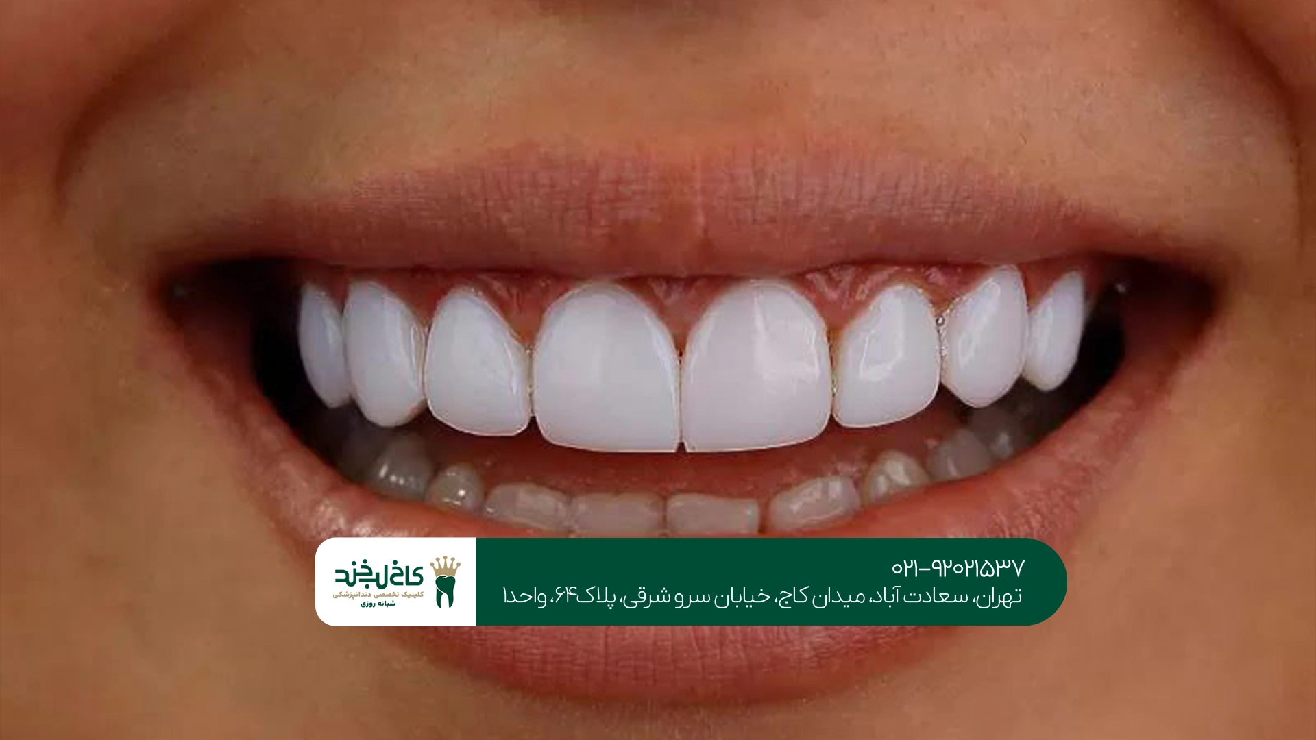 تفاوت روکش تمام سرامیک و زیرکونیا