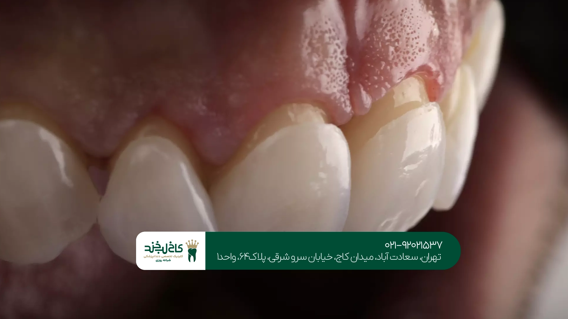 برترین مرکز روکش دندان تهران