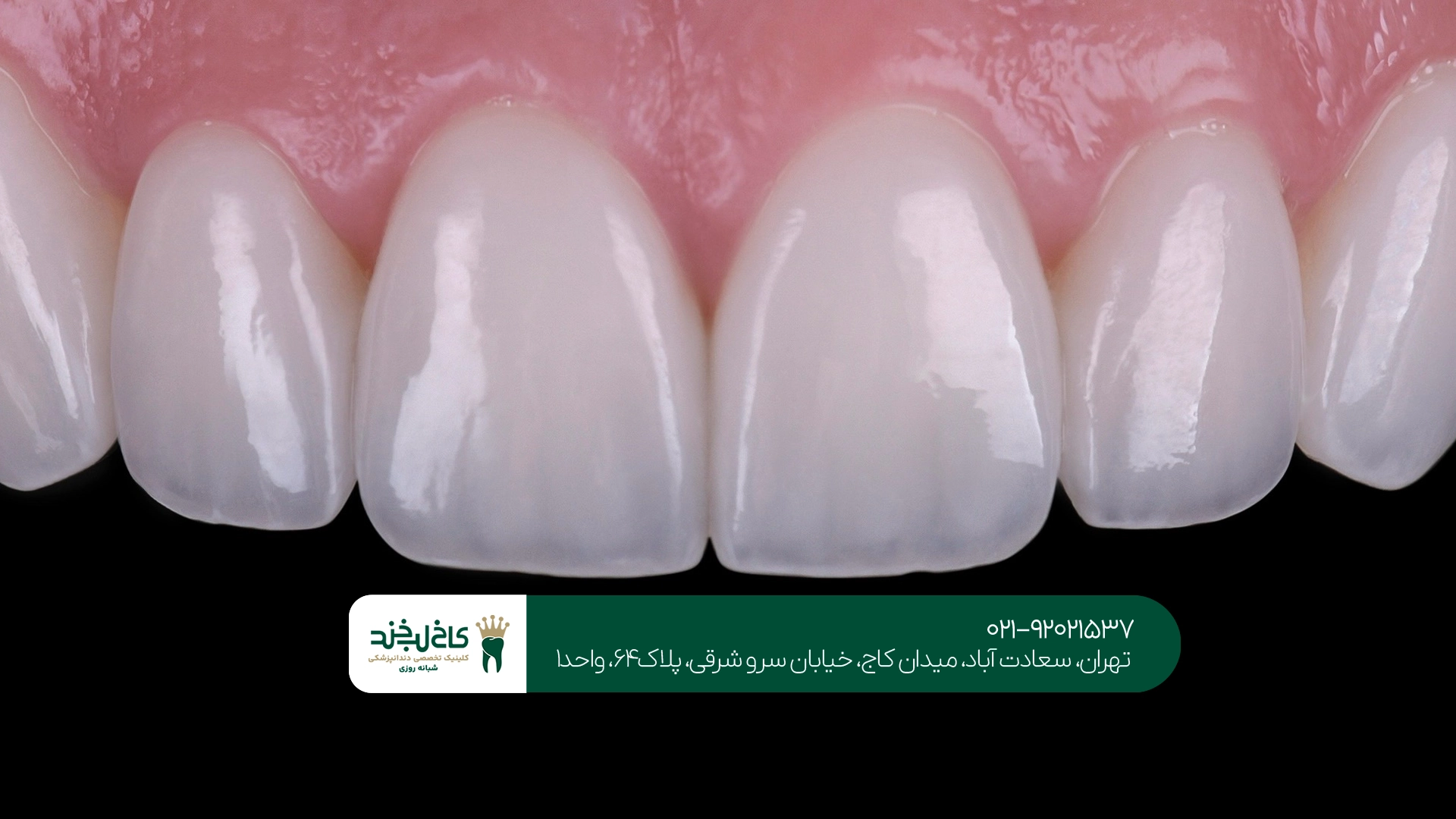 بهترین مرکز روکش دندان تهران