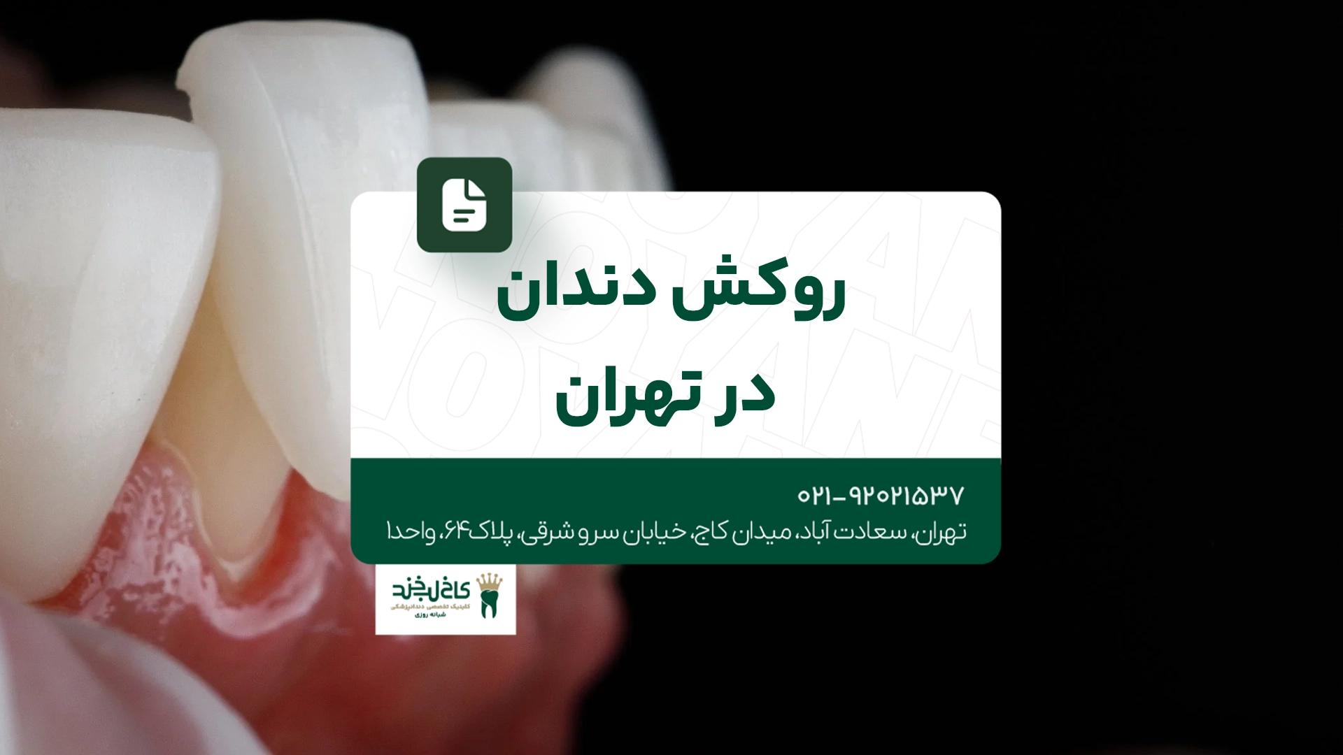 روکش دندان در تهران