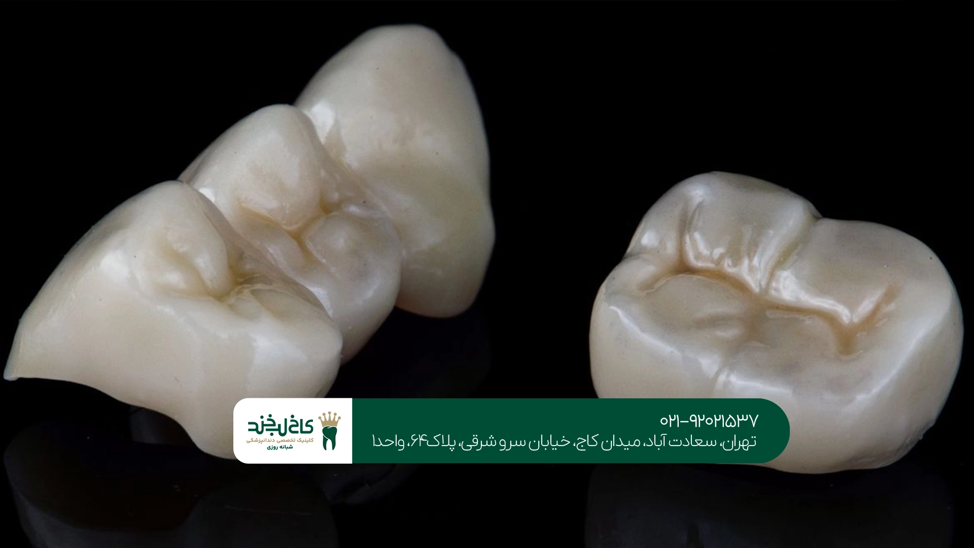 روکش دیجیتال روکش دیجیتال