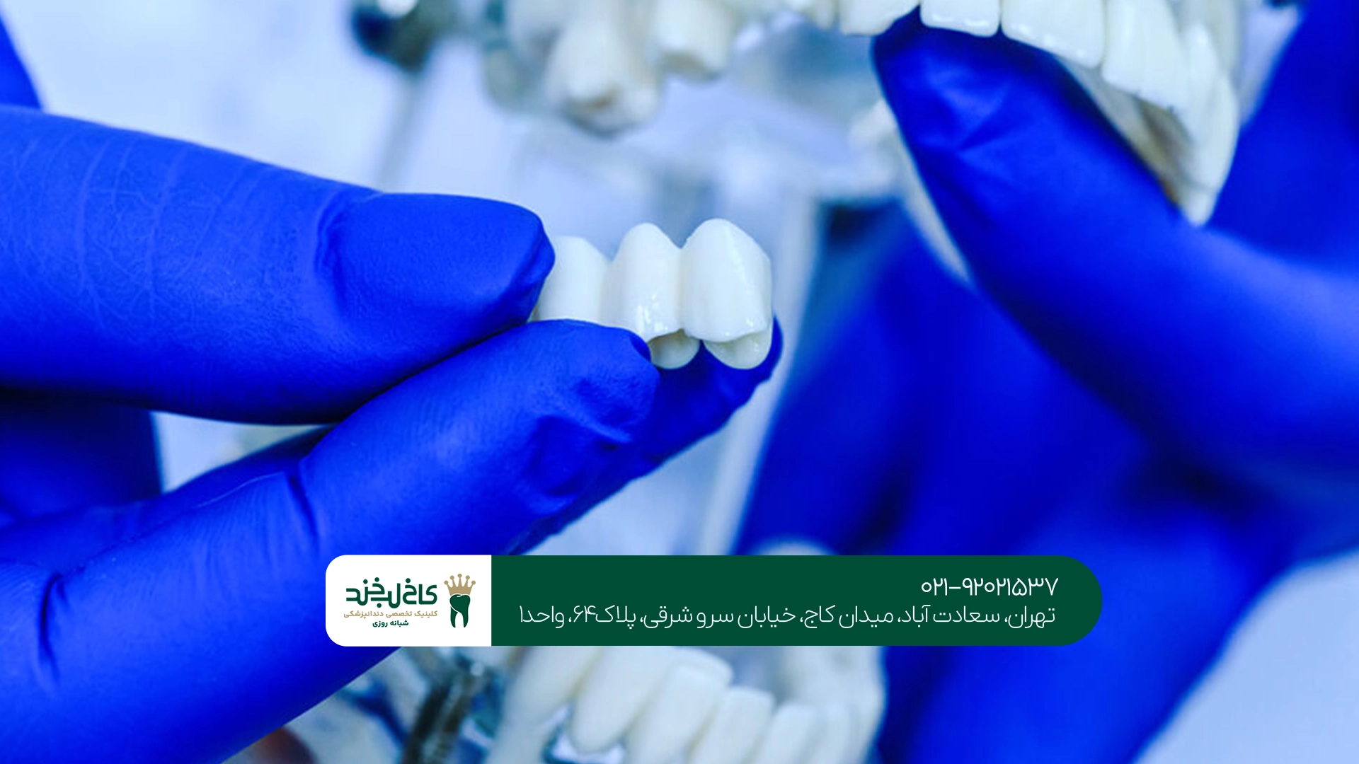 انواع روکش دندان دیجیتال انواع روکش دندان دیجیتال