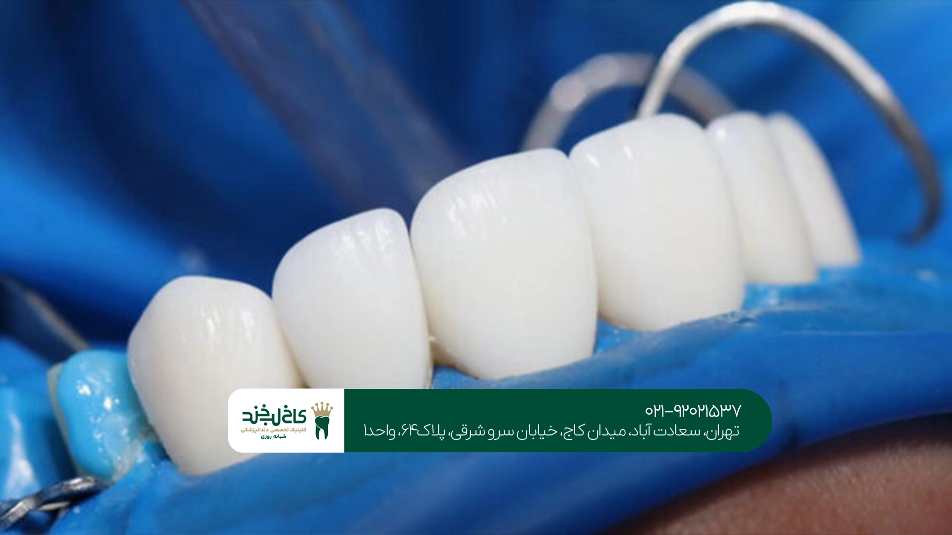روکش دندان دیجیتال بعد از عصبکشی روکش دندان دیجیتال بعد از عصبکشی