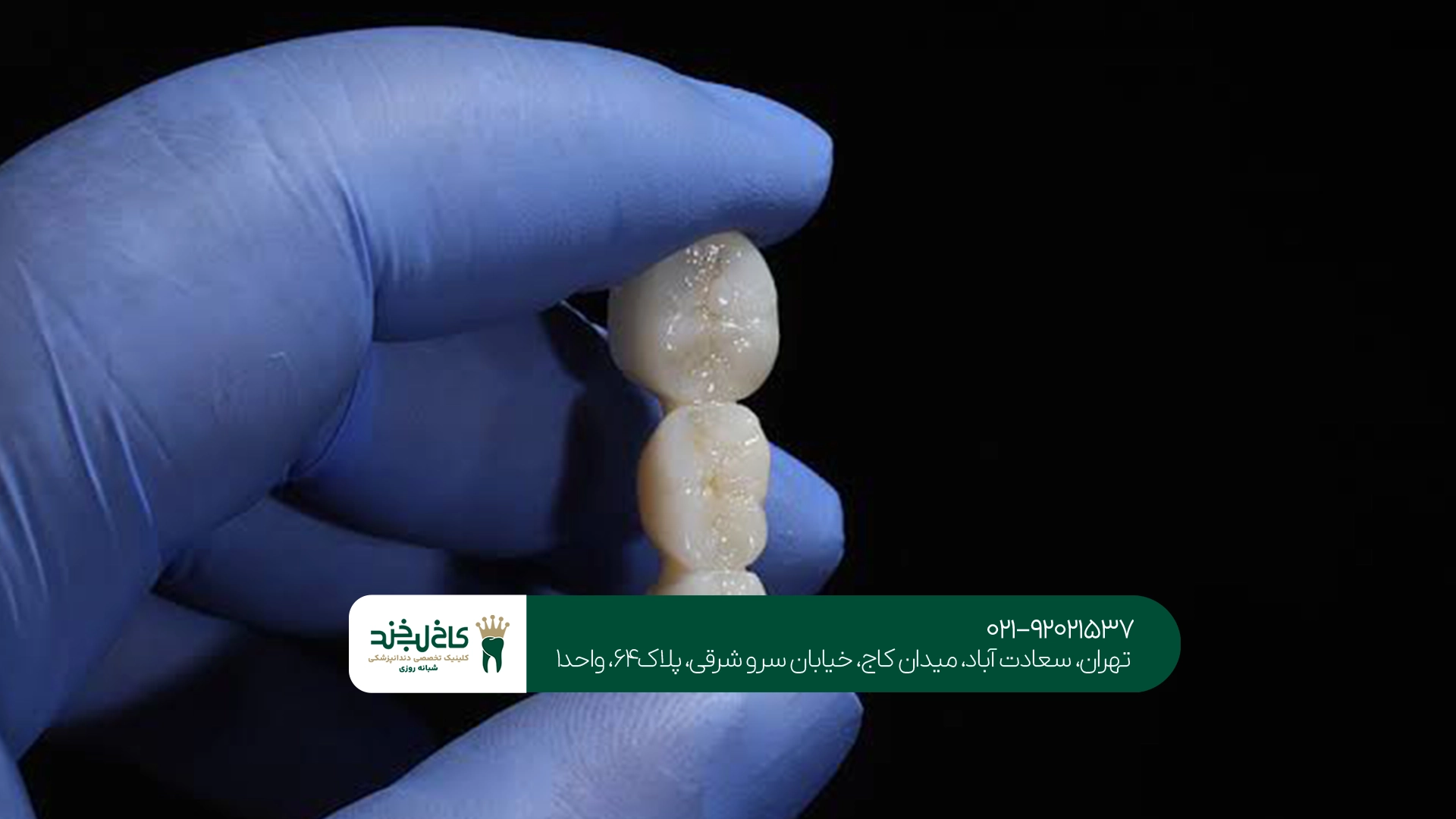 ماندگاری روکش دندان دیجیتال چقدر است؟ ماندگاری روکش دندان دیجیتال چقدر است؟
