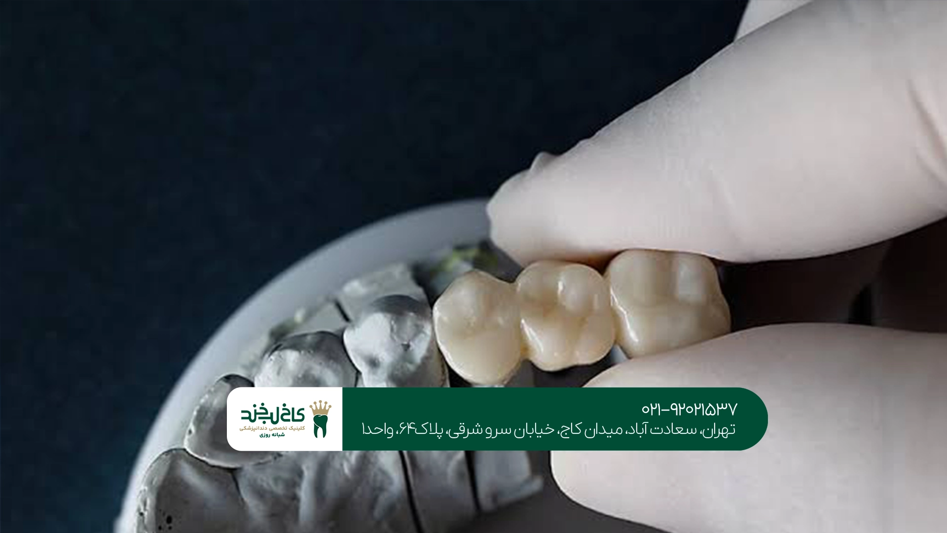 مراقبت از روکش دندان دیجیتال مراقبت از روکش دندان دیجیتال