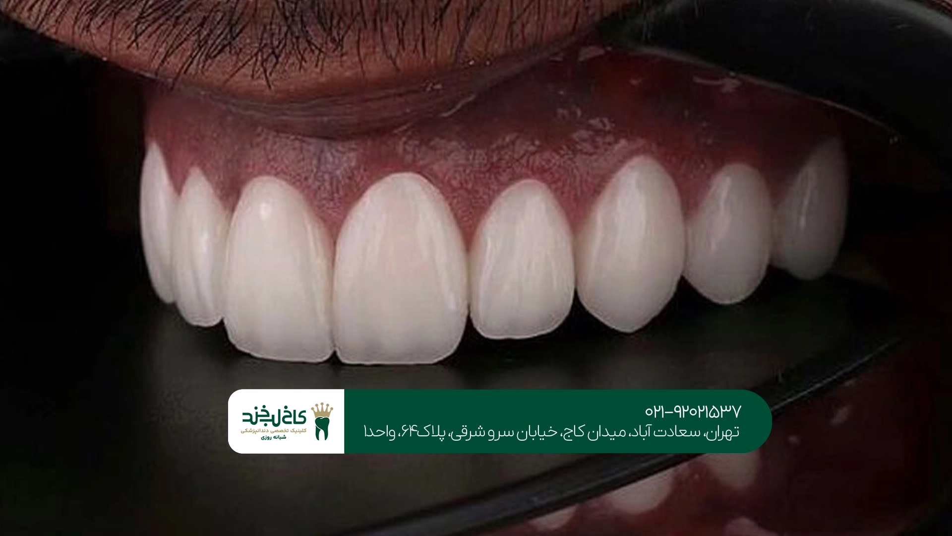 بهترین مرکز پر کردن دندان در تهران