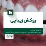 روکش زیبایی