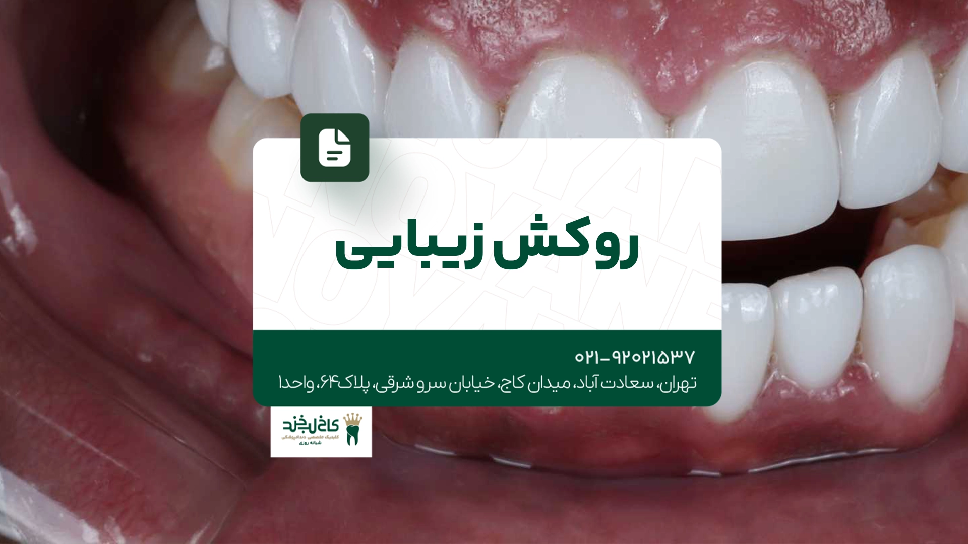 روکش زیبایی