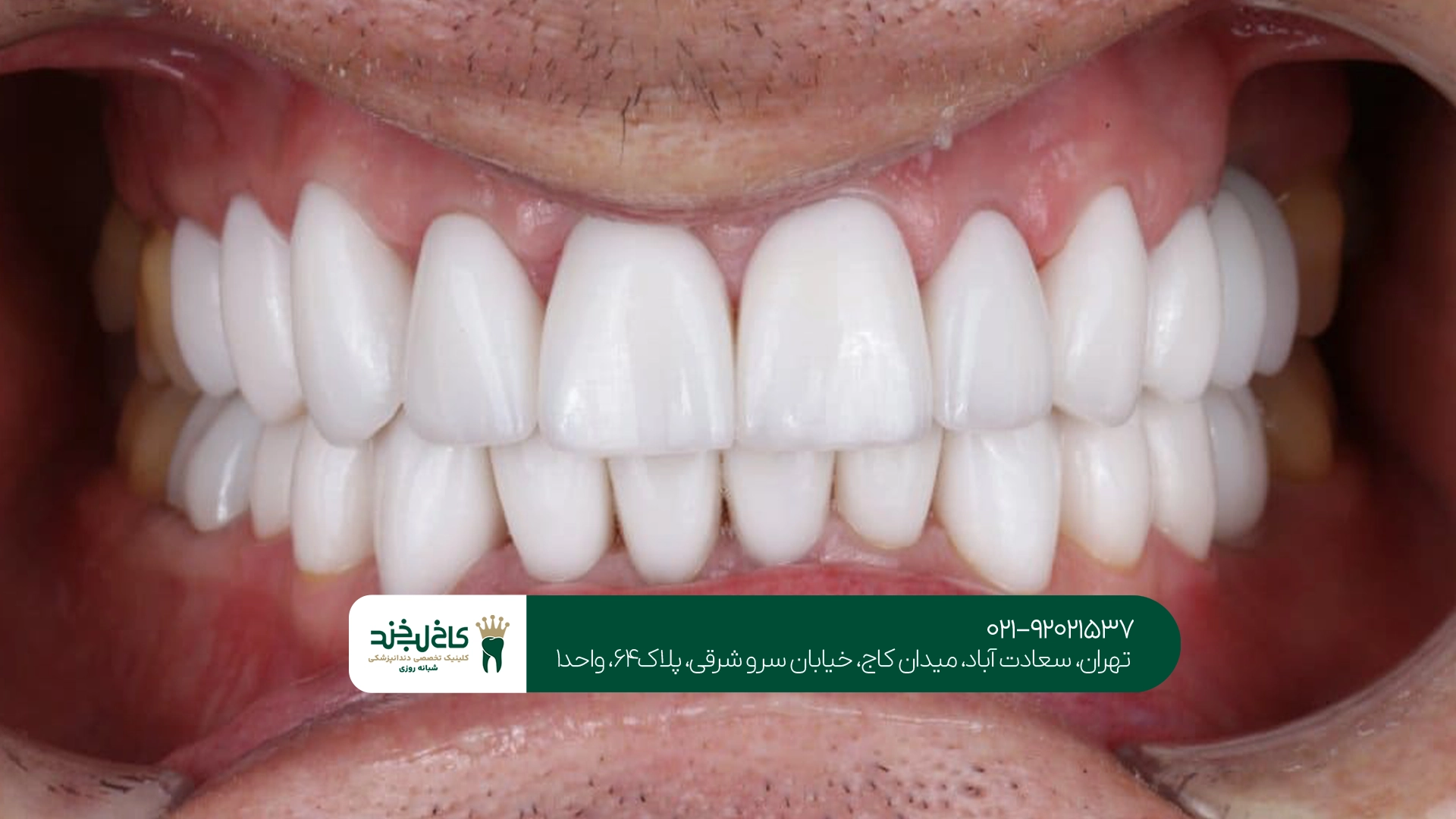 مراحل انجام روکش زیبایی دندان چگونه است؟