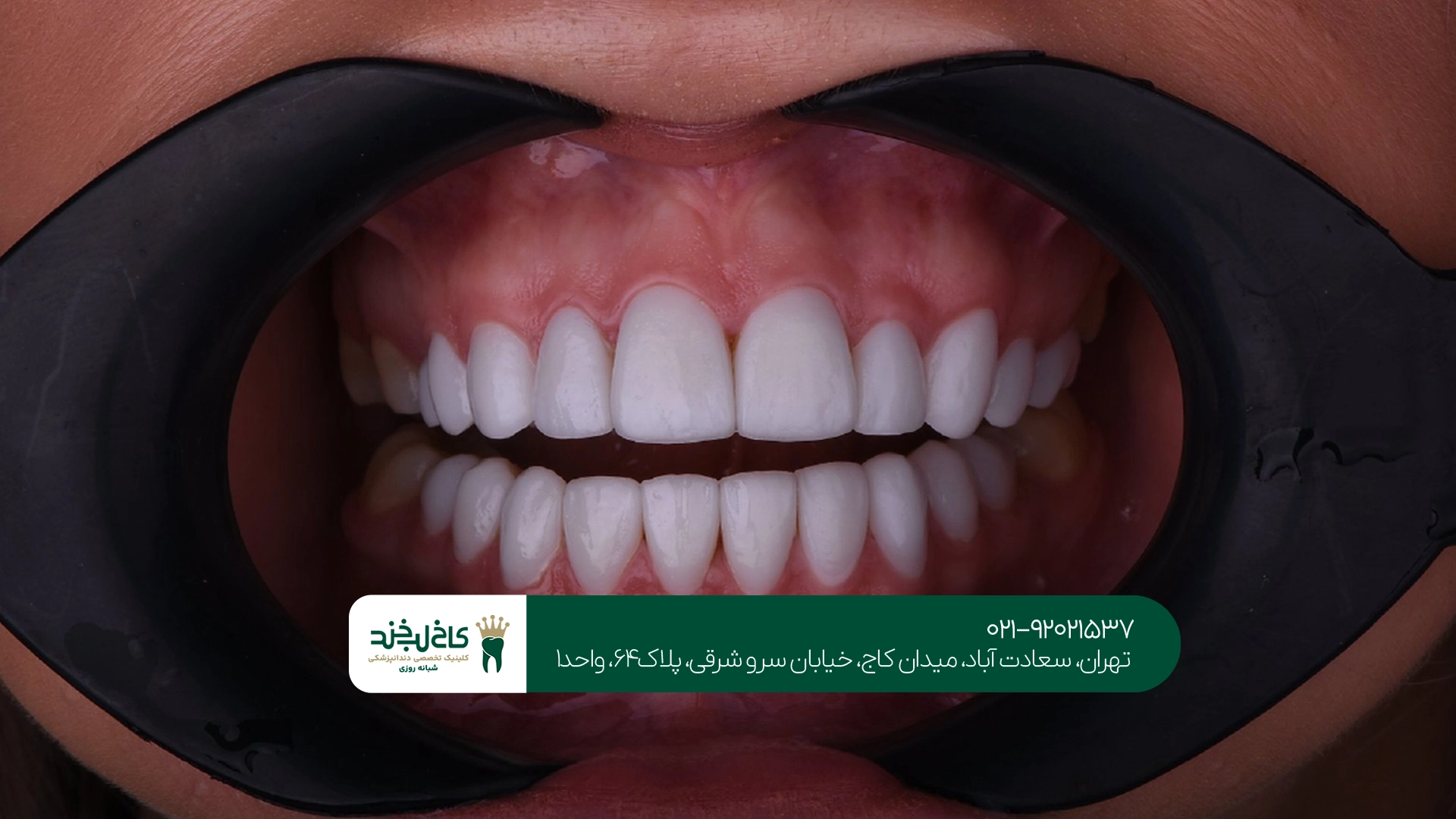 روکش زیبایی دندان در تهران