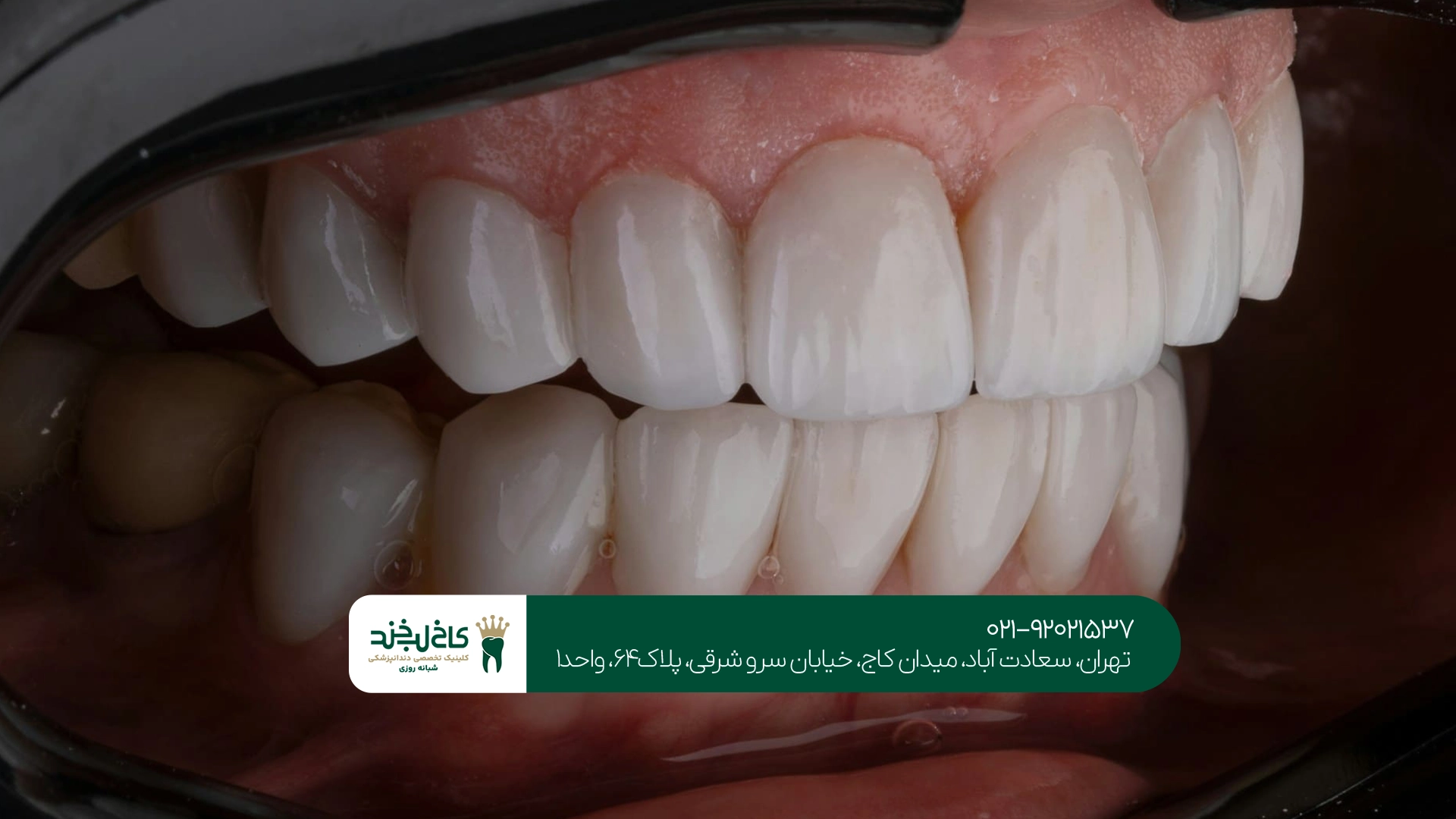 انجام روکش زیبایی دندان