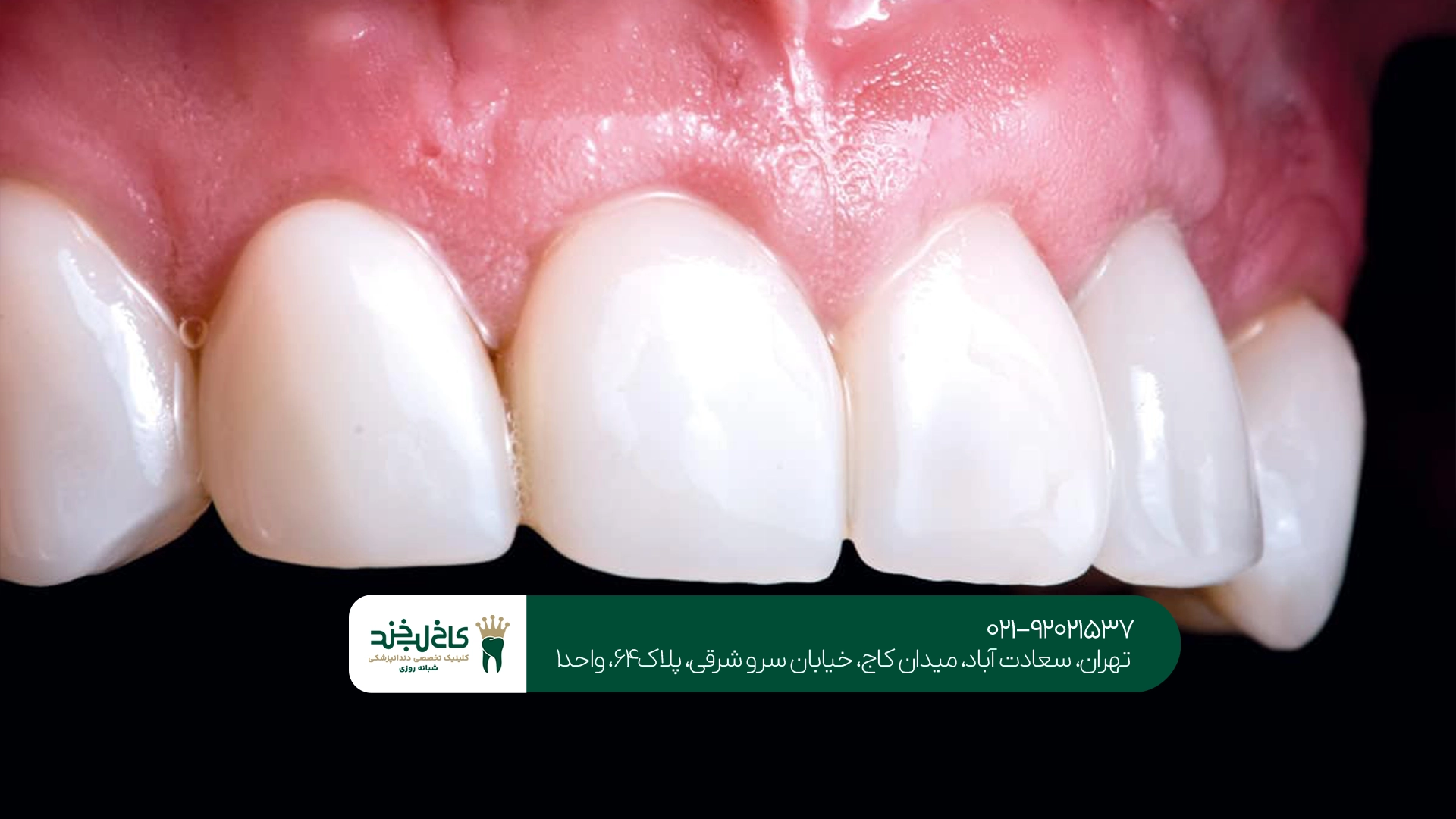 تفاوت روکش زیرکونیا با روکش سرامیکی