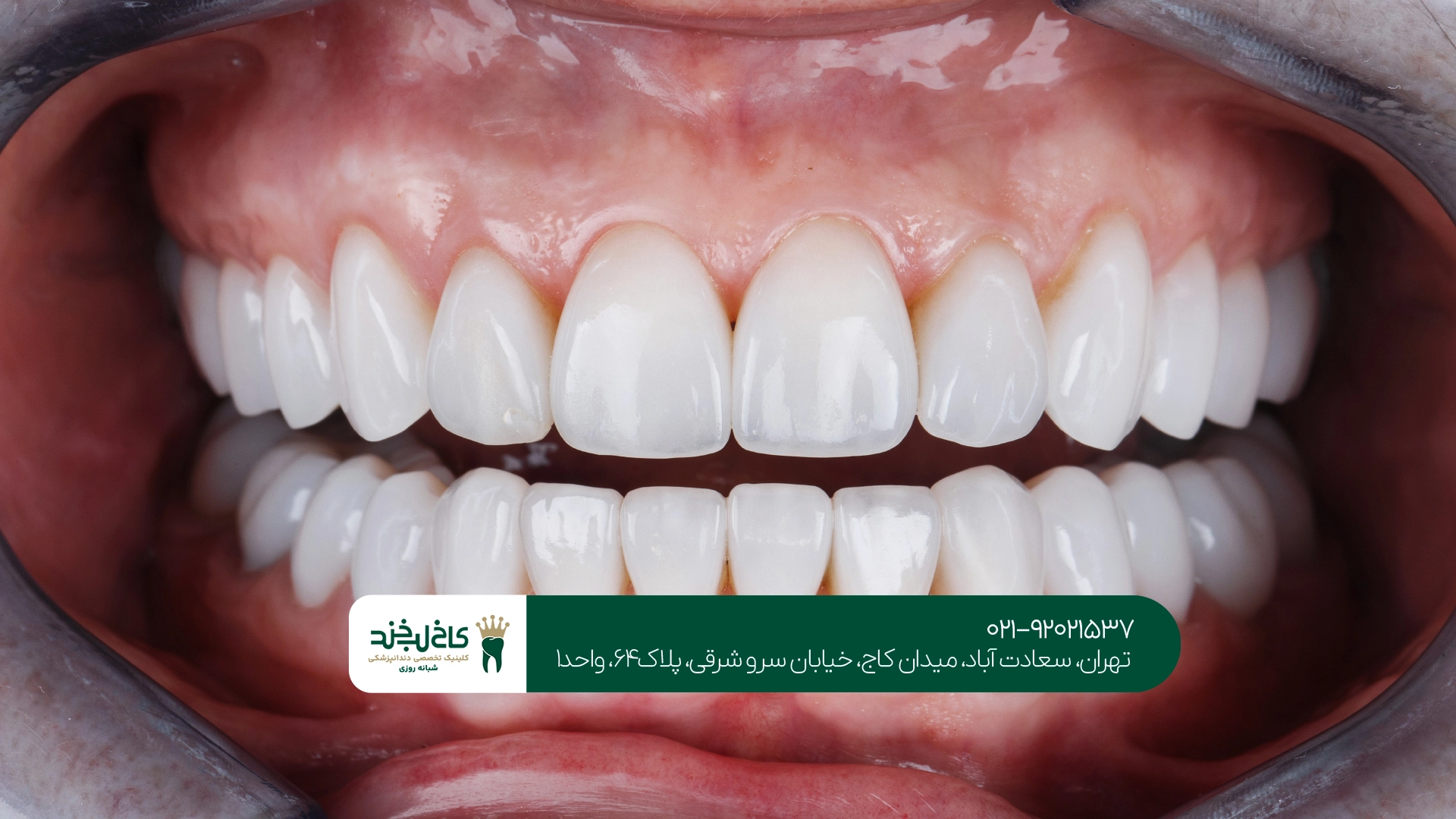 کلینیک روکش زیرکونیا اقساطی در تهران